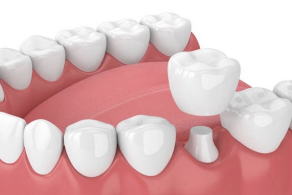 Dịch vụ răng sứ thẩm mỹ