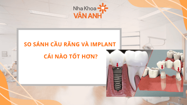 SO SÁNH CẦU RĂNG VÀ IMPLANT CÁI NÀO TỐT HƠN?