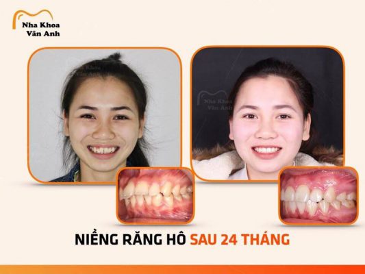 Niềng răng trả góp tại Bắc Ninh