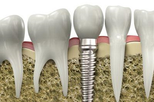 Trồng răng toàn hàm Implant là phương pháp gì?