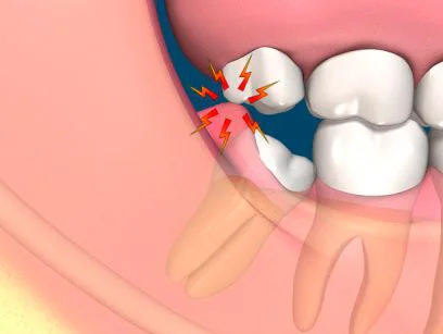 Có phải ai cũng phải mọc răng khôn? Tại sao có người không mọc? Có phải ai cũng phải mọc răng khôn? Tại sao có người không mọc?