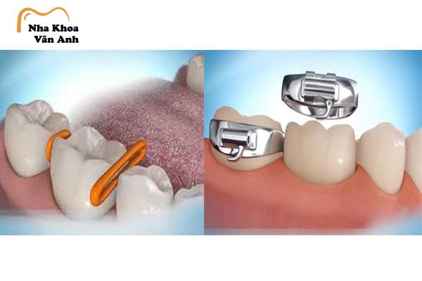 Gắn thun, tách kẽ răng là giai đoạn răng bạn sẽ đau nhất nhưng sẽ hết trong vòng 7 ngày đầu tiên Gắn thun, tách kẽ răng là giai đoạn răng bạn sẽ đau nhất nhưng sẽ hết trong vòng 7 ngày đầu tiên