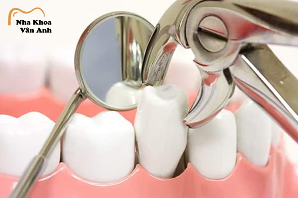 Tùy vào từng trường hợp răng, bác sĩ sẽ đưa ra chỉ định có nhổ răng hay không? Tùy vào từng trường hợp răng, bác sĩ sẽ đưa ra chỉ định có nhổ răng hay không?