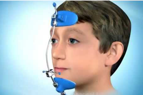 niềng răng móm ở trẻ