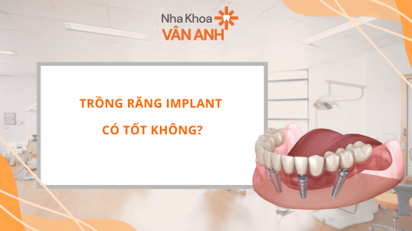 trồng răng implant có tốt không