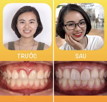 Răng sứ thẩm mĩ Bắc Ninh 2