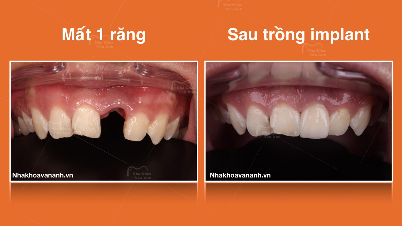 Giải pháp nào tốt nhất cho người mất răng - Nha khoa Vân Anh