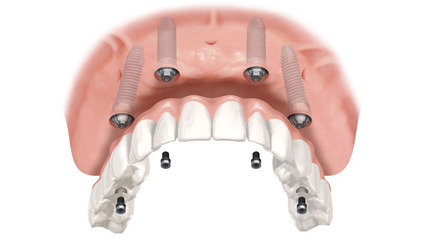 Trồng răng toàn hàm Implant là phương pháp gì? 2