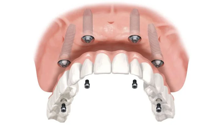 Trồng răng toàn hàm Implant