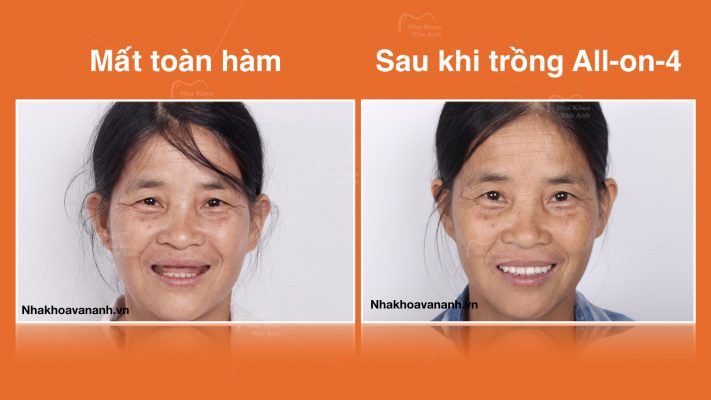 Khách hàng trồng All-on-4 tại Nha Khoa Vân Anh
