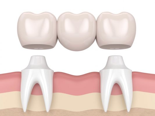 Cầu răng sứ (hình ảnh minh hoạ)