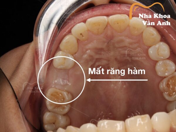 Mất răng hàm làm giảm khả năng ăn nhai