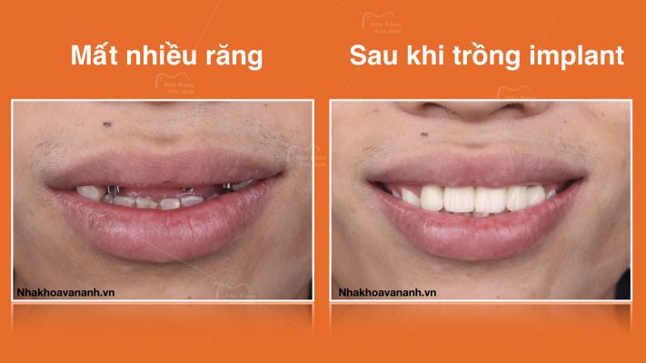 Khách hàng mất nhiều răng tại Nha Khoa Vân Anh