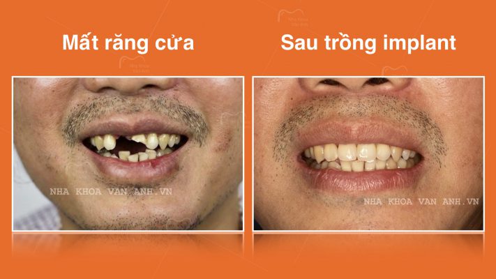 Trước và sau khi trồng implant răng cửa tại Nha Khoa vân Anh