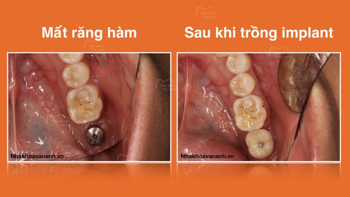 Hình ảnh khách hàng mất răng hàm