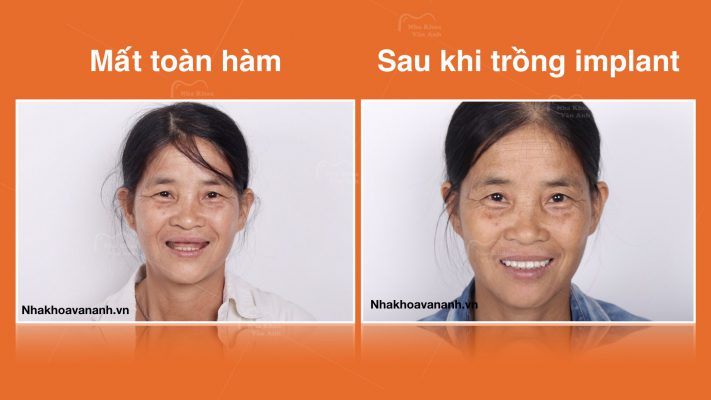 Khách hàng mất toàn bộ răng hàm trên
