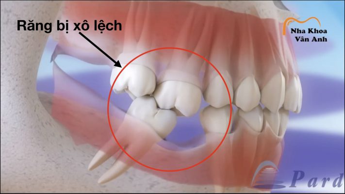 Răng xô lệch khi mất răng lâu ngày