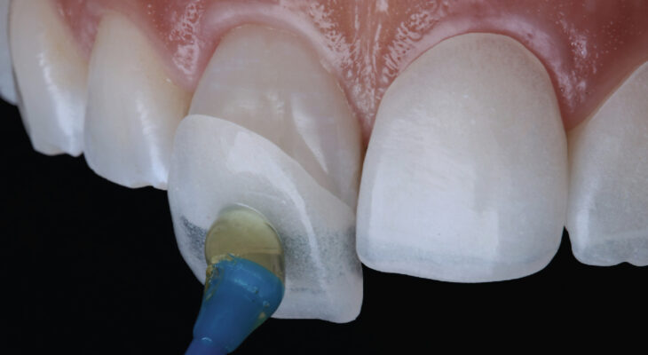 Mặt dán sứ chỉ mỏng từ 0,3 - 0,5mm