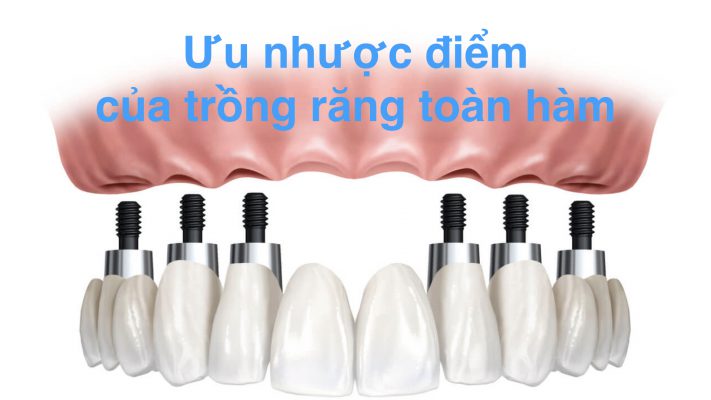 ưu nhược điểm của trồng răng toàn hàm