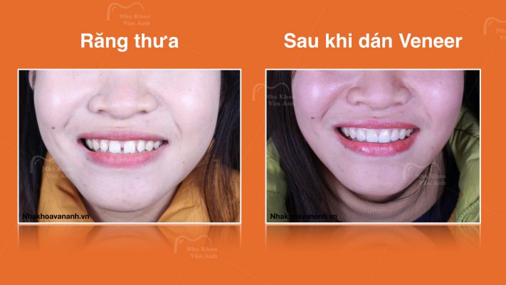 Khách hàng dán Veneer tại Nha Khoa Vân Anh