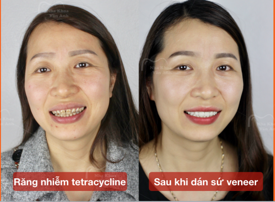 Khách hàng sau dán sứ Veneer tại Nha Khoa Vân Anh
