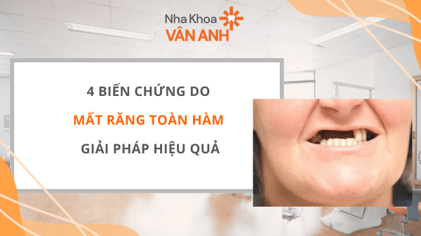chứng do mất răng toàn hàm