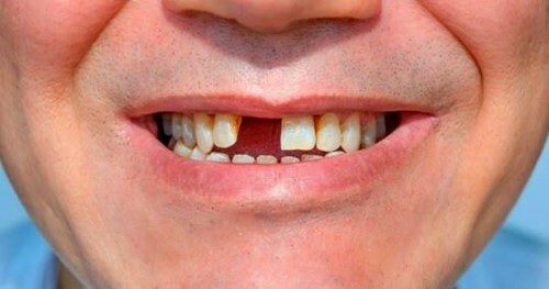 5 hậu quả khi mất răng 1