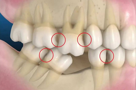 5 hậu quả khi mất răng 2