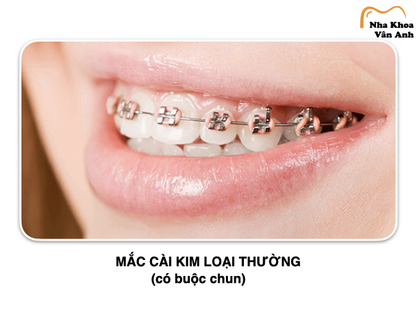 Niềng răng mắc cài kim loại thường là một trong các loại niềng răng có chi phí rẻ nhất hiện nay Niềng răng mắc cài kim loại thường là một trong các loại niềng răng có chi phí rẻ nhất hiện nay
