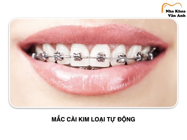 Mắc cài kim loại tự động cũng thuộc top các loại niềng răng được ưa chuộng hiện nay Mắc cài kim loại tự động cũng thuộc top các loại niềng răng được ưa chuộng hiện nay