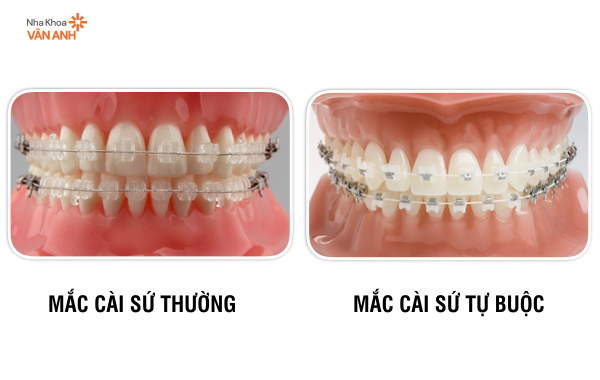 Mắc cài sứ