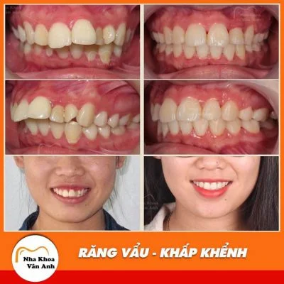 nieng-rang-uy-tin-tai-bac-giang