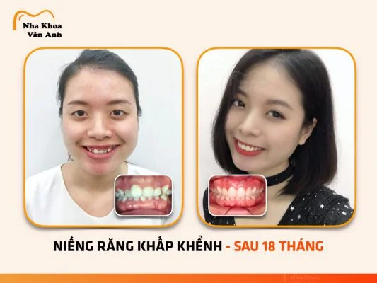 nieng-rang-uy-tin-tai-bac-giang-1