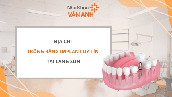 Địa chỉ trồng răng Implant uy tín tại Lạng Sơn