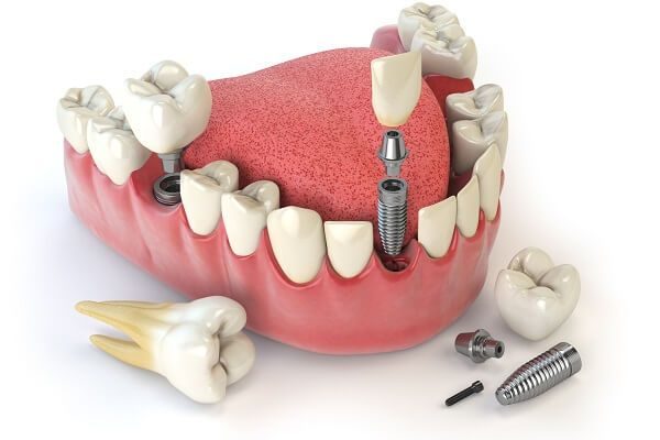 Dịch vụ trồng răng Implant