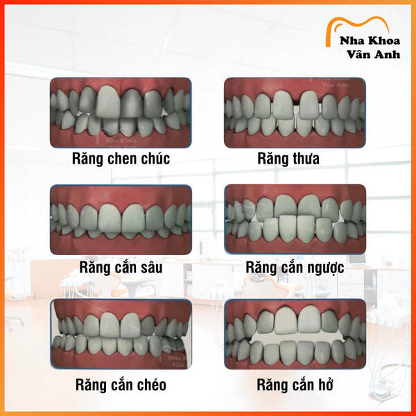 Các trường hợp răng có thể điều trị bằng Invisalign