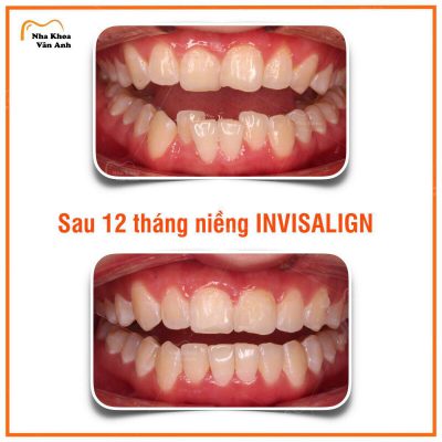 dia-chi-nha-khoa-nieng-rang-trong-suot-Invisalign-uy-tin-tai-bac-giang-2