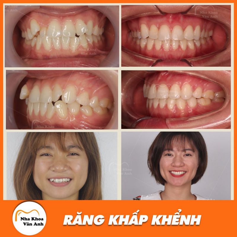 Niềng răng giúp khắc phục hiệu quả tình trạng răng khấp khểnh