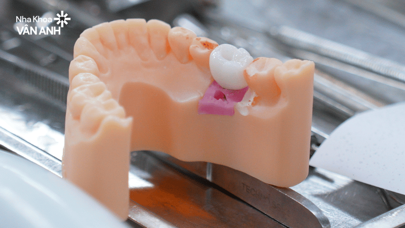 răng sứ nha khoa vân anh