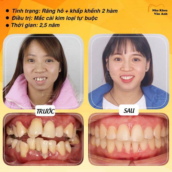 Nieng-rang-mac-cai-loai-nao-tot-nhat-gia-bao-tien-2020-8