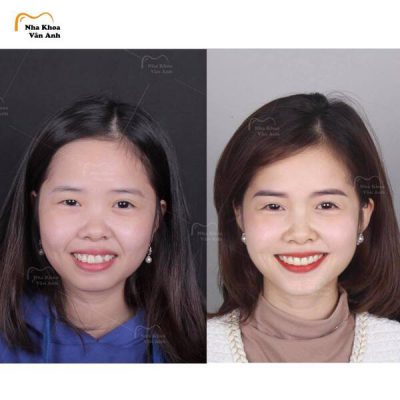 thay-doi-sau-khi-nieng