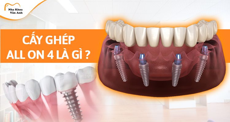 Cấy ghép Implant all on 4