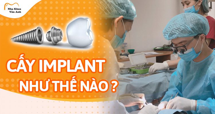Quá trình cấy ghép Implant