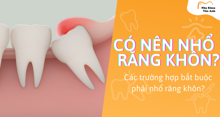 co-nen-nho-rang-khon-khong