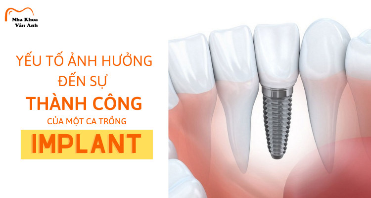 yeu-to-anh-huong-den-su-thanh-cong-cua-trong-rang-implant