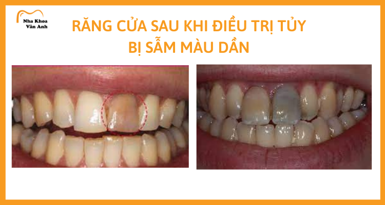 Rang-bi-den-sau-khi-lay-tuy