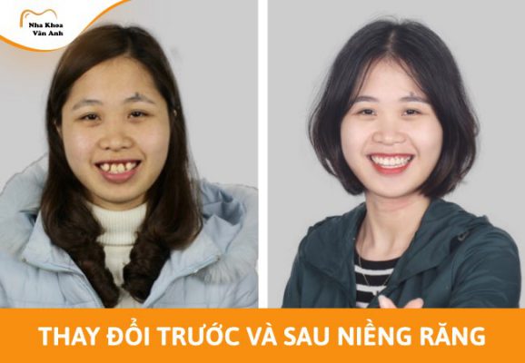 Thay đổi trước và sau niềng răng