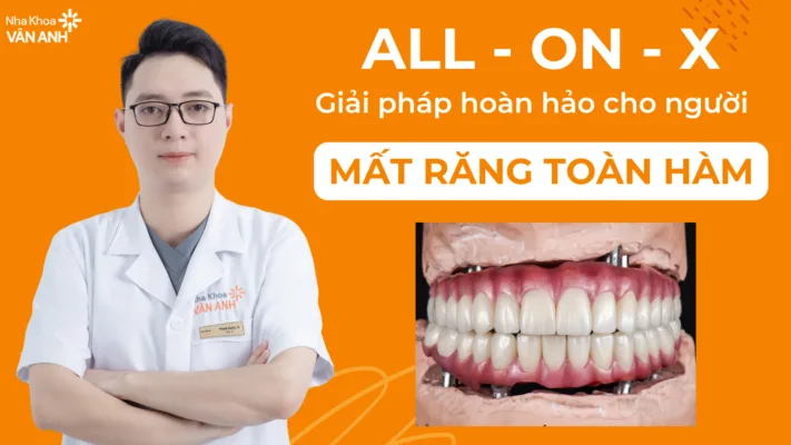trồng răng Implant All on 4 giá bao nhiêu 