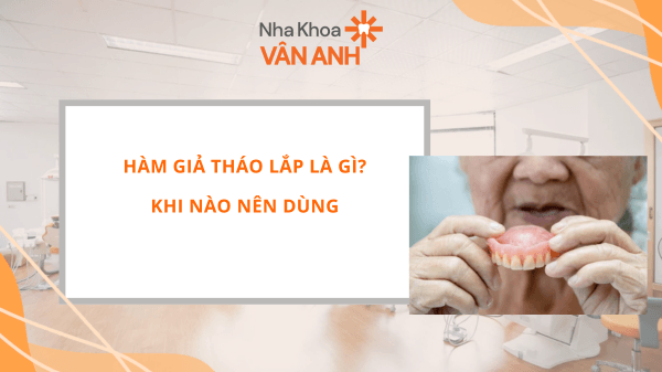 HÀM GIẢ THÁO LẮP LÀ GÌ