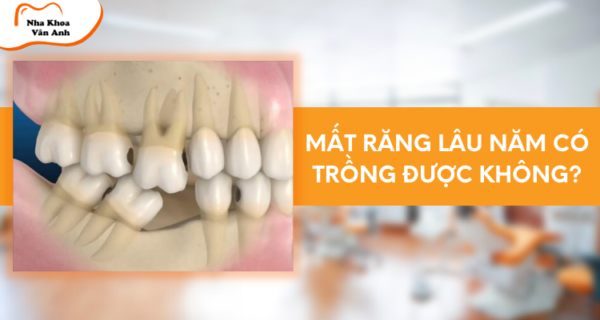 Mất răng lâu năm có trồng lại được không